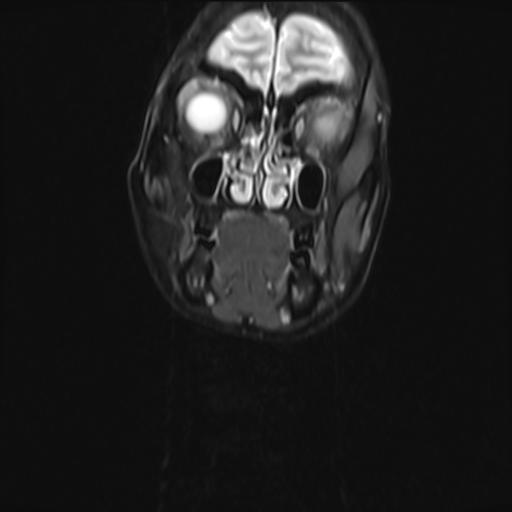 File:Bilateral carotid body tumors and right jugular paraganglioma (Radiopaedia 20024-20060 Coronal 48).jpg