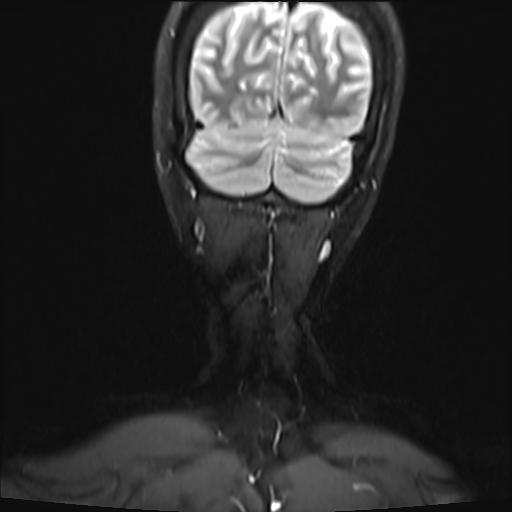 File:Bilateral carotid body tumors and right jugular paraganglioma (Radiopaedia 20024-20060 Coronal 50).jpg