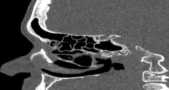 File:Bilateral ectopic infraorbital nerves (Radiopaedia 49006-54084 Sagittal 12).png