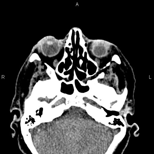 Bilateral enlargement of lacrimal glands - sarcoidosis (Radiopaedia 62627-70921 Axial non-contrast 31).jpg
