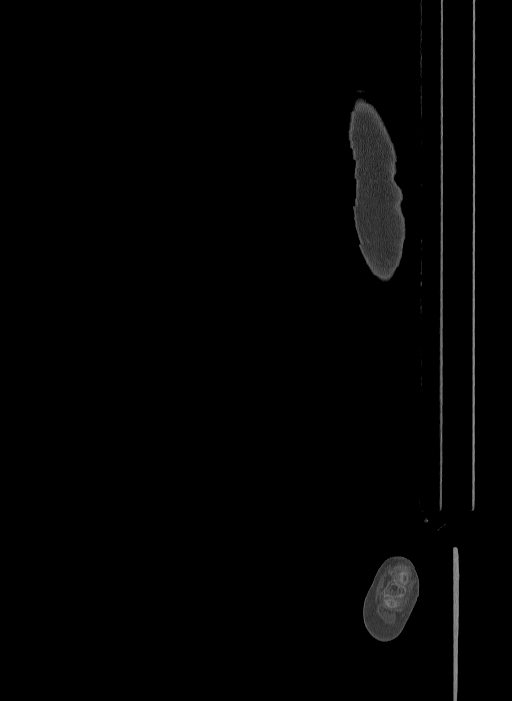Bilateral fibular hemimelia type II (Radiopaedia 69581-79491 Sagittal bone window 17).jpg