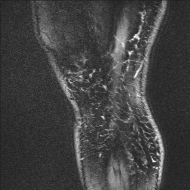 Bilateral focal pigmented villonodular synovitis (Radiopaedia 67643-77073 Sagittal T1 vibe 2).jpg