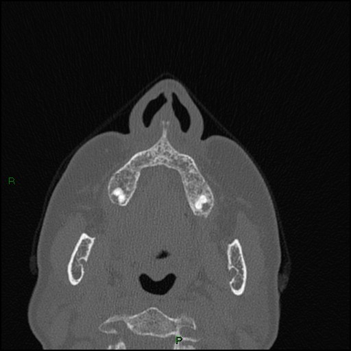 Bilateral frontal mucoceles (Radiopaedia 82352-96454 Axial bone window 242).jpg