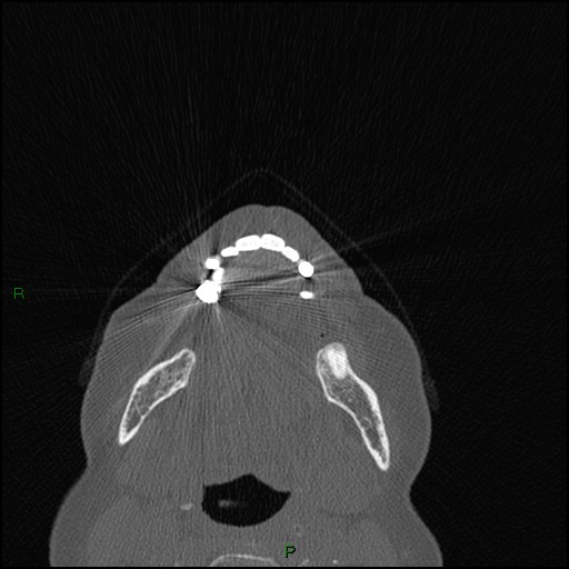 Bilateral frontal mucoceles (Radiopaedia 82352-96454 Axial bone window 293).jpg