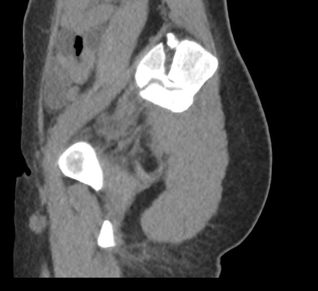 Bilateral mature cystic ovarian teratoma (Radiopaedia 88821-105592 D 58).jpg