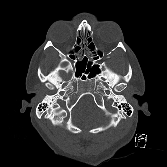 Bilateral occipital condyle fracture (type 2) (Radiopaedia 87675-104089 Axial bone window 20).jpg