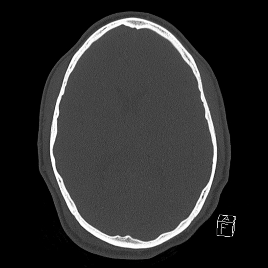 Bilateral occipital condyle fracture (type 2) (Radiopaedia 87675-104089 Axial bone window 77).jpg