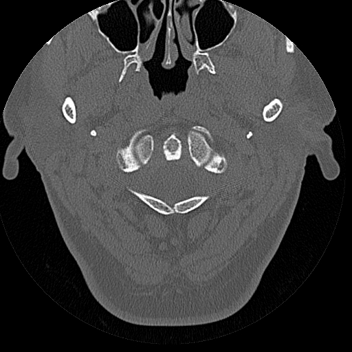 File:Bilateral ossifications of the external auditory canal (Radiopaedia 15233-15076 Axial bone window 31).jpg
