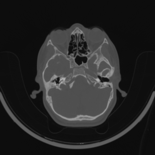 Bilateral otosclerosis (Radiopaedia 57237-64157 C 39).jpg