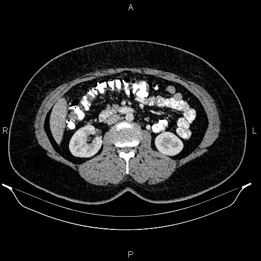 Bilateral ovarian dermoid cysts (Radiopaedia 85785-101603 A 51).jpg