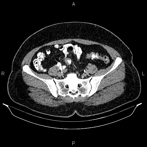 Bilateral ovarian dermoid cysts (Radiopaedia 85785-101603 Axial C+ delayed 61).jpg