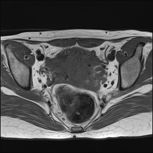 File:Bilateral ovarian endometriomas (Radiopaedia 87085-103347 Axial T1 12).jpg