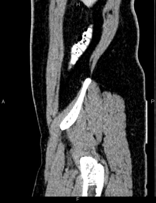 Bilateral ovarian teratoma (Radiopaedia 83131-97503 D 27).jpg