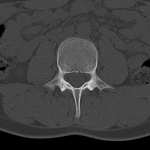 Bilateral pars defect (Radiopaedia 26691-26846 Axial bone window 4).jpg