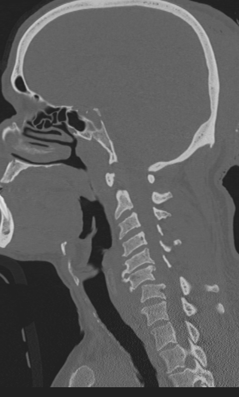 Bilateral perched facet joint (Radiopaedia 63149-71669 Sagittal bone window 37).jpg