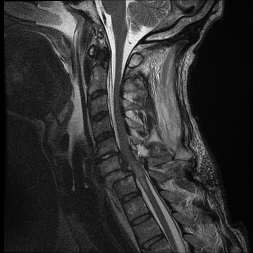File:Bilateral perched facets with cord injury (Radiopaedia 45587-49714 Sagittal T2 7).jpg