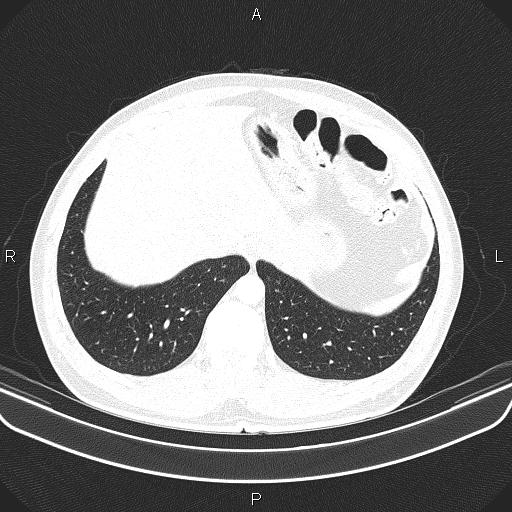 File:Bilateral pulmonary AVM (Radiopaedia 83134-97505 Axial lung window 63).jpg