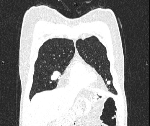 Bilateral pulmonary AVM (Radiopaedia 83134-97505 Coronal lung window 21).jpg