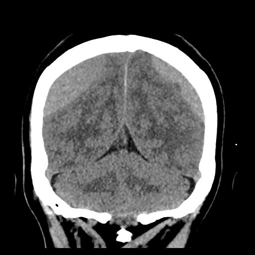 File:Bilateral subacute subdural hematoma (Radiopaedia 69240-79018 Coronal non-contrast 44).jpg