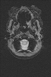 Bilateral subdural hemorrhage and parietal skull fracture (Radiopaedia 26058-26190 Axial SWI 2).png