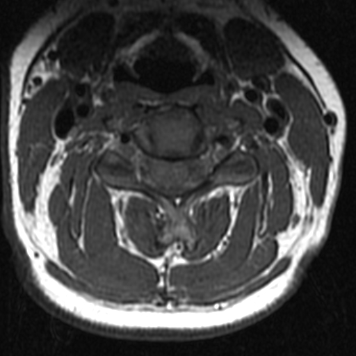 File:Bilateral tortuous vertebral arteries (Radiopaedia 19070-19039 Axial T2 14).jpg