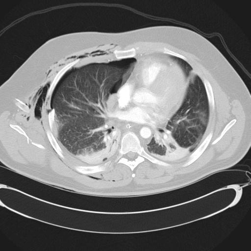 Bilateral traumatic renovascular injury (Radiopaedia 32051-32995 Axial lung window 29).jpg