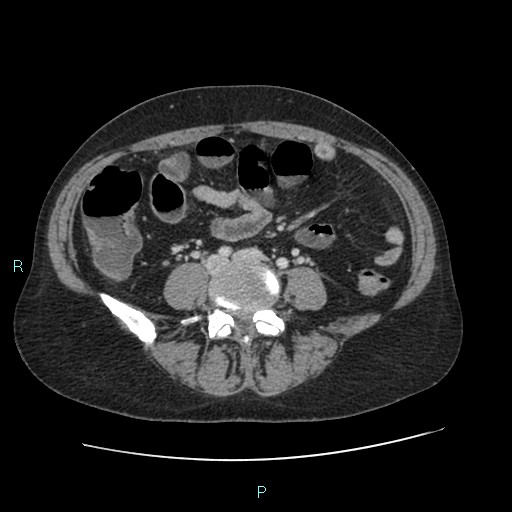 File:Bilateral tubo-ovarian abscesses (Radiopaedia 48737).jpg