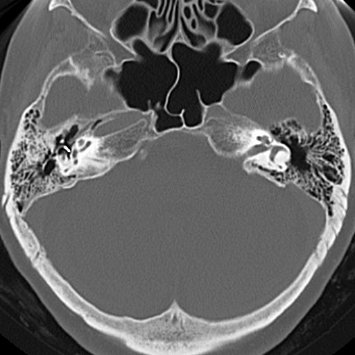 File:Bilateral tympanoplasty (Radiopaedia 16947-16664 Axial bone window 12).jpg