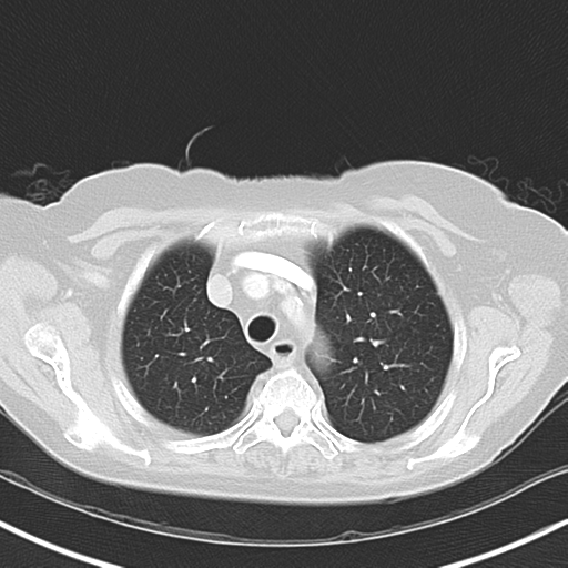 File:Bladder and bowel cancers (Radiopaedia 37688-39592 Axial lung window 12).png
