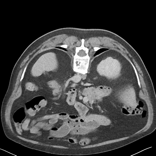 File:Bladder papillary urothelial carcinoma (Radiopaedia 48119-52951 Axial C+ delayed 13).png