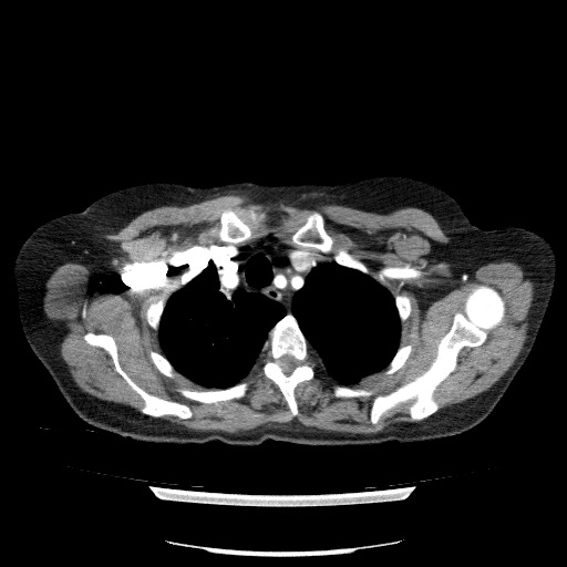 Bladder tumor detected on trauma CT (Radiopaedia 51809-57609 A 20).jpg