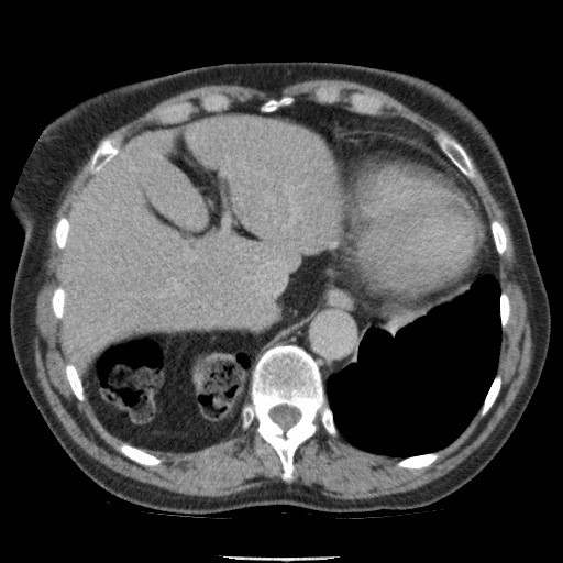 Bladder tumor detected on trauma CT (Radiopaedia 51809-57609 C 26).jpg