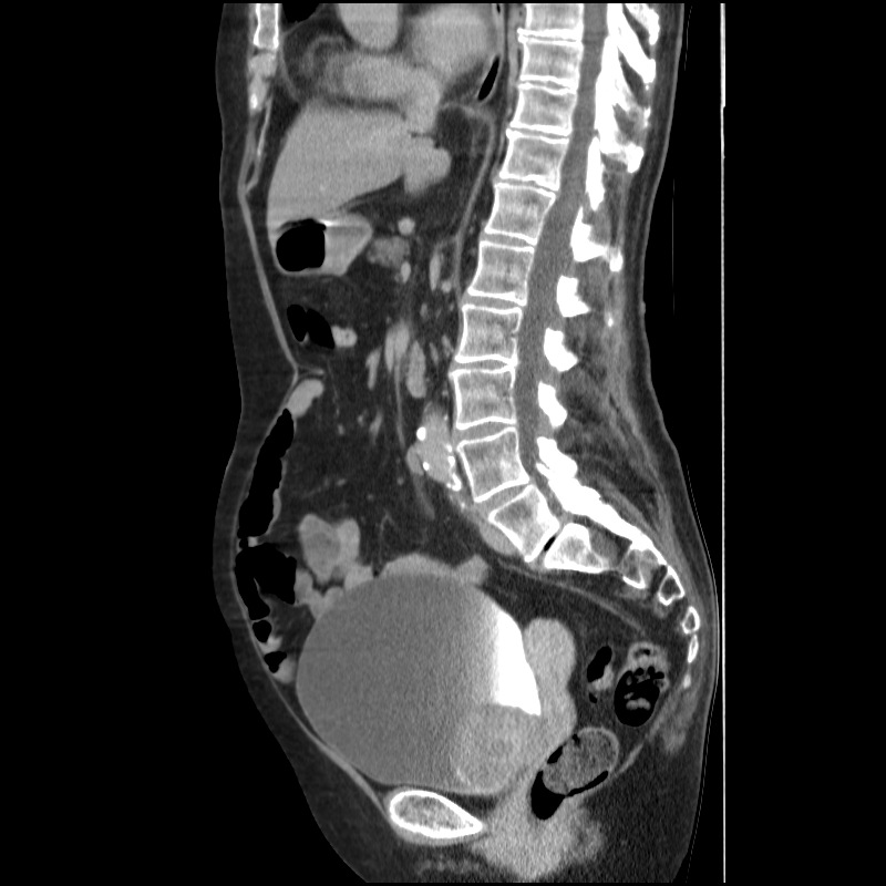 Bladder tumor detected on trauma CT (Radiopaedia 51809-57609 E 36).jpg