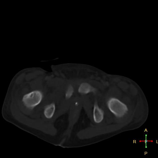 File:Blunt abdominal trauma (Radiopaedia 24780-25044 Axial bone window 20).jpg