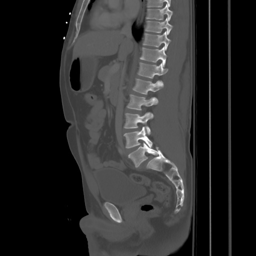 Blunt abdominal trauma with solid organ and musculoskelatal injury with active extravasation (Radiopaedia 68364-77895 Sagittal bone window 46).jpg