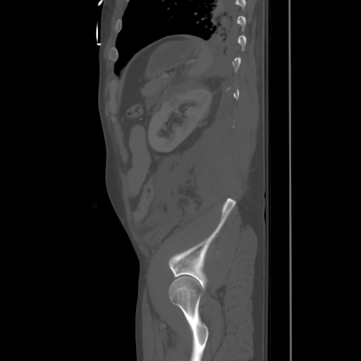 Blunt abdominal trauma with solid organ and musculoskelatal injury with active extravasation (Radiopaedia 68364-77895 Sagittal bone window 86).jpg