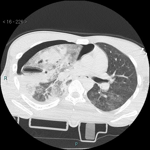 Blunt chest trauma (Swiss cheese sign) (Radiopaedia 38519-40618 Axial lung window 31).jpg