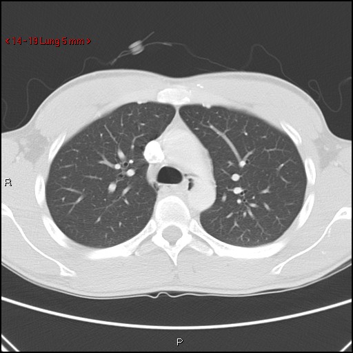 File:Blunt chest trauma - pulmonary interstitial emphysema and pneumomediastinum (Radiopaedia 20666-20552 Axial lung window 19).jpg