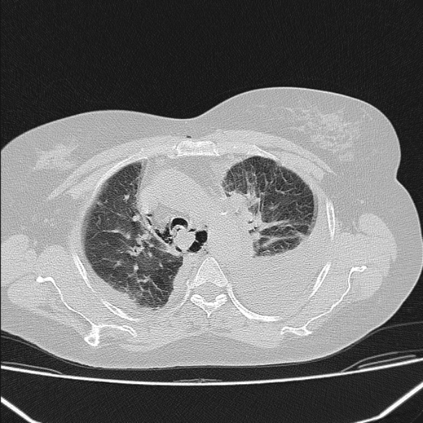 Boerhaave syndrome (Radiopaedia 45644-49799 Axial lung window 47).jpg