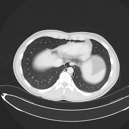 File:Boerhaave syndrome with mediastinal, axillary, neck and epidural free gas (Radiopaedia 41297-44115 Axial lung window 70).jpg