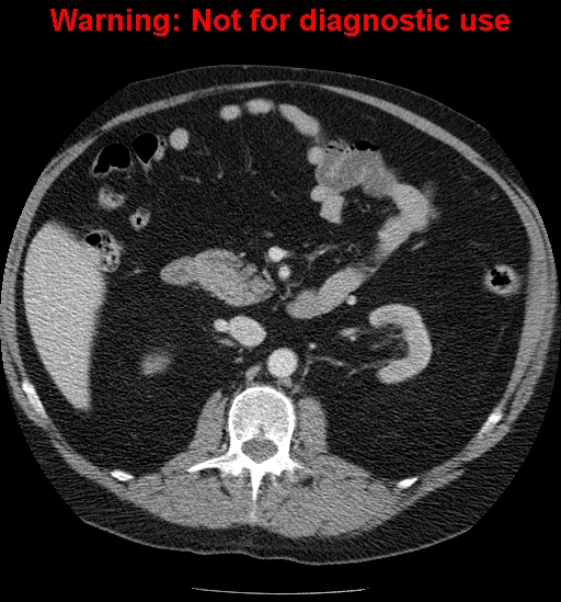 File:Bosniak renal cyst - type IV (Radiopaedia 23402-23466 D 29).jpg