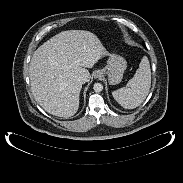 Bosniak renal cyst - type IV (Radiopaedia 24244-24518 C 49).jpg
