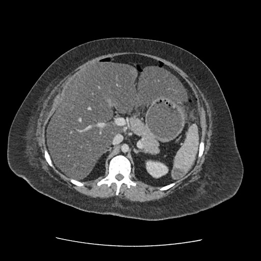 Bowel and splenic infarcts in acute lymphocytic leukemia (Radiopaedia 61055-68915 A 49).jpg