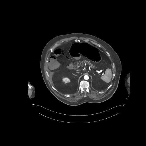 File:Bowel ischemia secondary to SMA occlusion with extensive portomesenteric venous gas (Radiopaedia 54656-60871 A 56).jpg