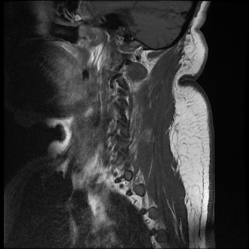 File:Brachial plexopathy (Radiopaedia 21844-21806 Sagittal T1 C+ 11).jpg