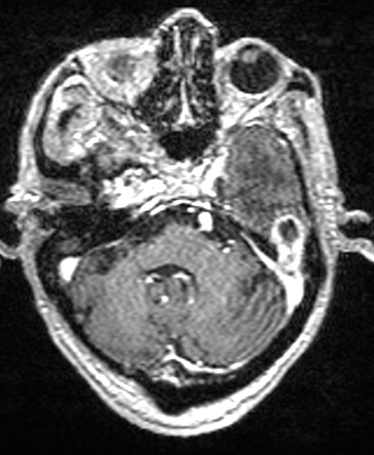 Brain abscess with dual rim sign (Radiopaedia 87566-103938 Axial T1 C+ 45).jpg