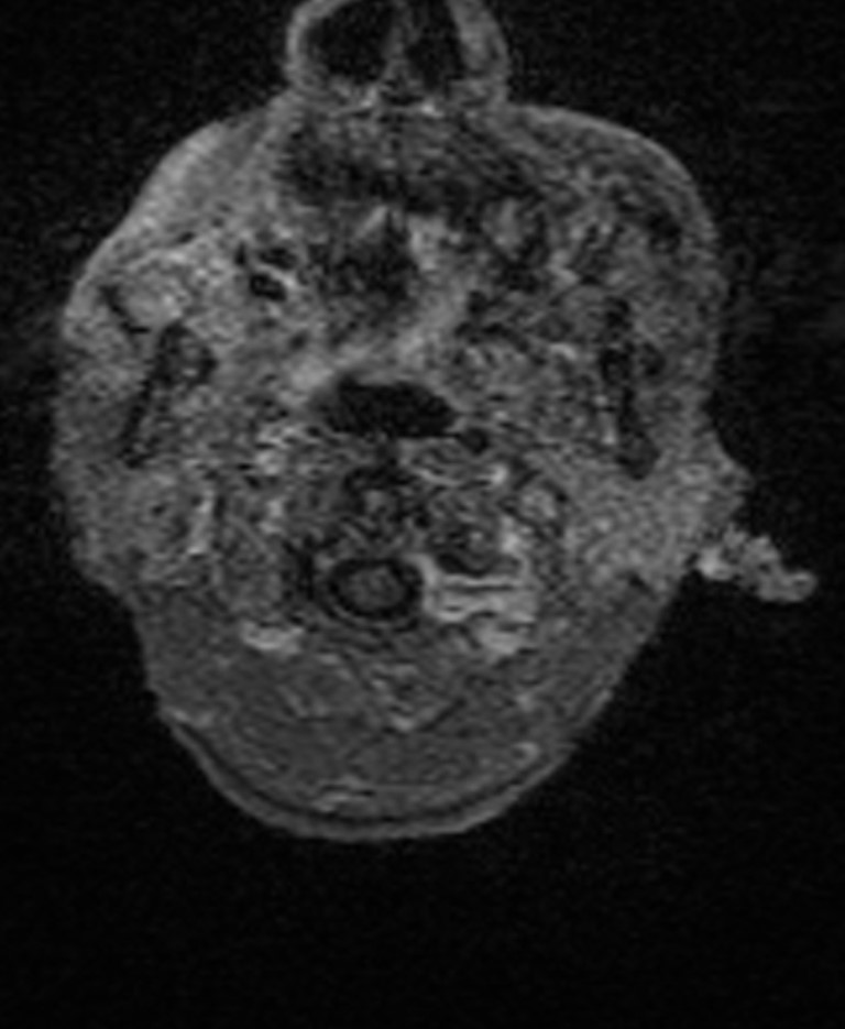 Brain abscess with dual rim sign (Radiopaedia 87566-103938 Axial T1 C+ 7).jpg