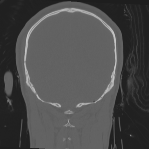 Brain contusions, internal carotid artery dissection and base of skull fracture (Radiopaedia 34089-35339 Coronal bone window 52).png