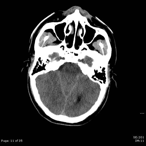 File:Brain death after motor vehicle collision (Radiopaedia 88470-105114 Axial non-contrast 11).jpg