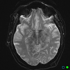 File:Brain death on MRI and CT angiography (Radiopaedia 42560-45689 Axial ADC 15).jpg